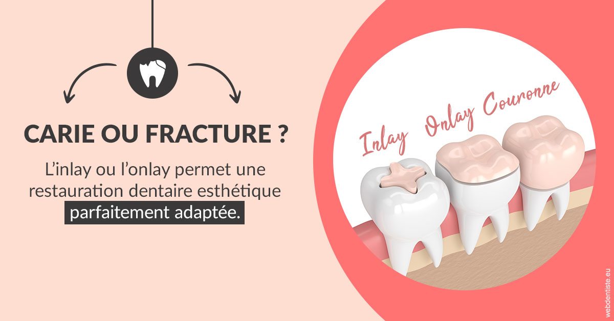 https://dr-vincent-dorothee.chirurgiens-dentistes.fr/T2 2023 - Carie ou fracture 2