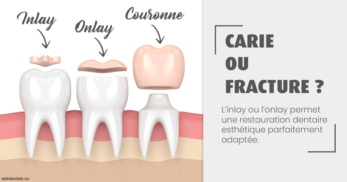 https://dr-vincent-dorothee.chirurgiens-dentistes.fr/T2 2023 - Carie ou fracture 1