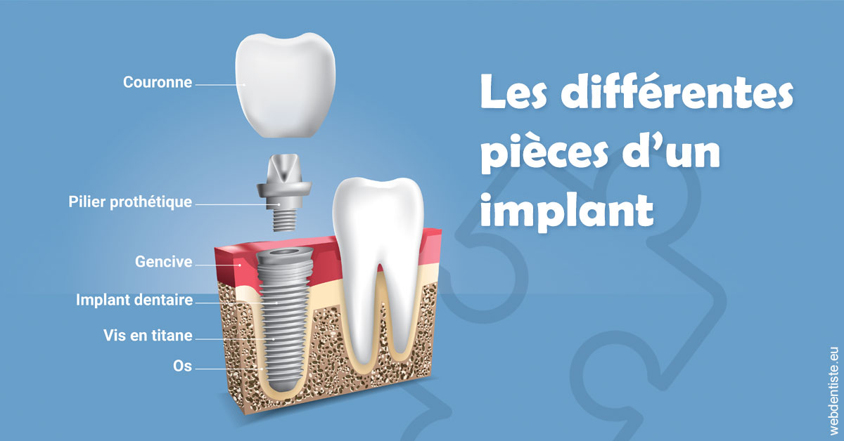 https://dr-vincent-dorothee.chirurgiens-dentistes.fr/Les différentes pièces d’un implant 1