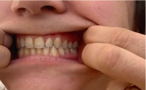 Comment faire des photos pour votre orthodontiste