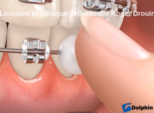 Mise en place de cire orthodontique